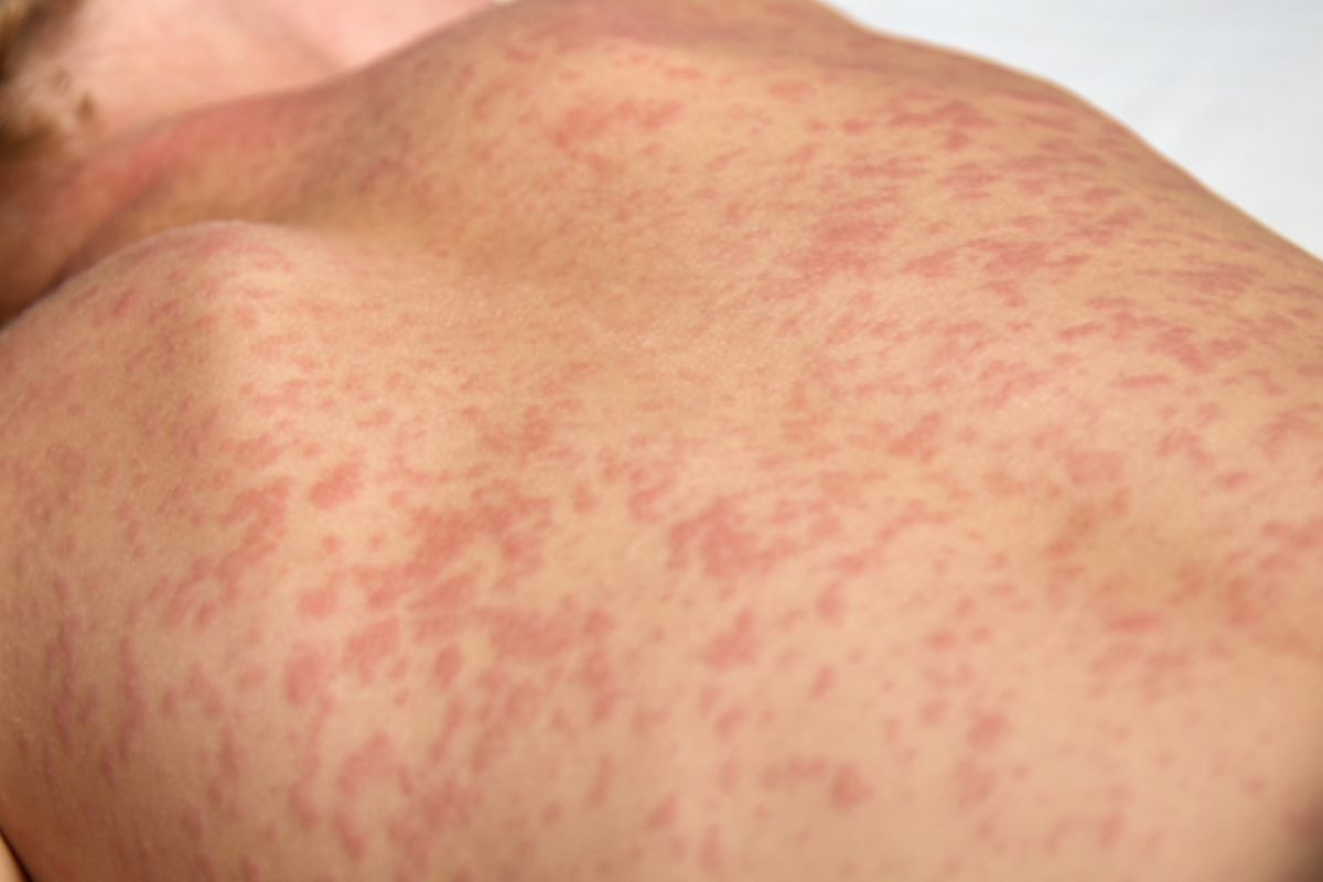 Sarampo volta a preocupar: Primavera do Leste confirma 4º caso e baixa vacinação acende alerta